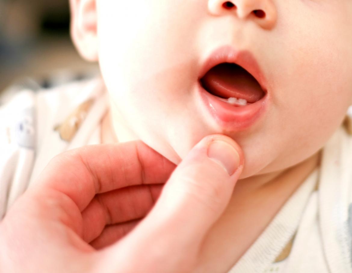 Mund von Baby mit 2 unteren Vorderzähnen Hand zeiht Lippe etwas nach unten